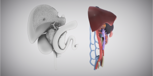 Whipple with extended right hepatectomy and right nephrectomy (Part II)