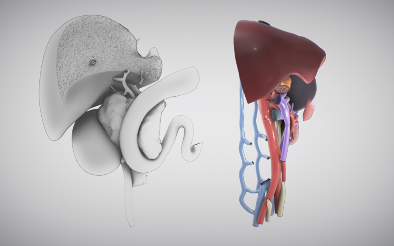 Whipple with extended right hepatectomy and right nephrectomy (Part II)