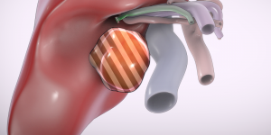 Laparoscopic segment V tumorectomy