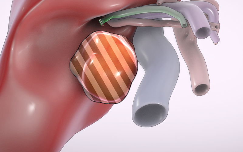 Laparoscopic segment V tumorectomy