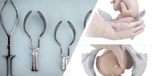 Assisted Vaginal Birth: Overview