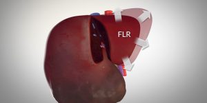 Rescue Associating Liver Partition and Portal Vein Ligation for Staged hepatectomy (ALPPS)