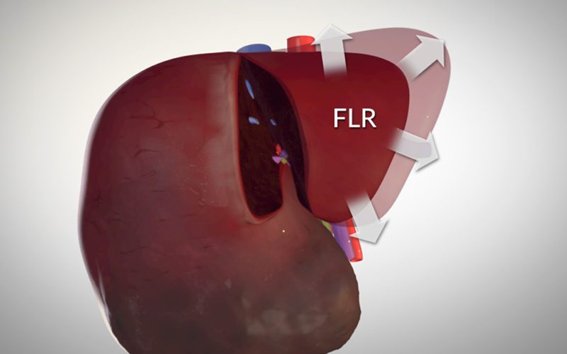 Rescue Associating Liver Partition and Portal Vein Ligation for Staged hepatectomy (ALPPS)