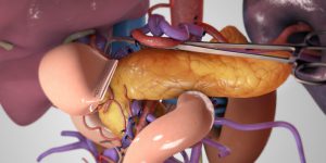 Total pancreatectomy with PV reconstruction to 2 SMV branches