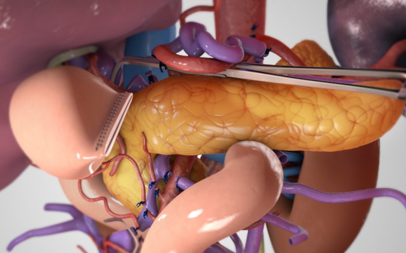 Total pancreatectomy with PV reconstruction to 2 SMV branches