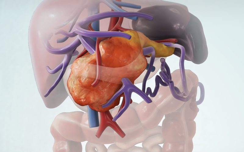 Ex vivo Whipple and small bowel autotransplantation for PNETs