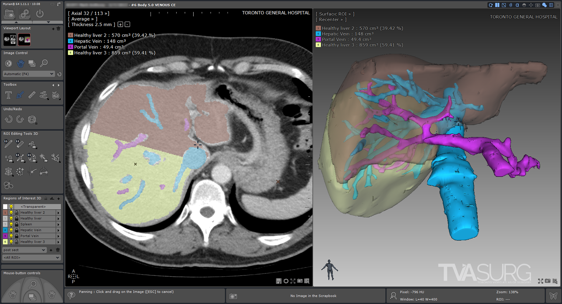 Right posterior donor sectionectomy