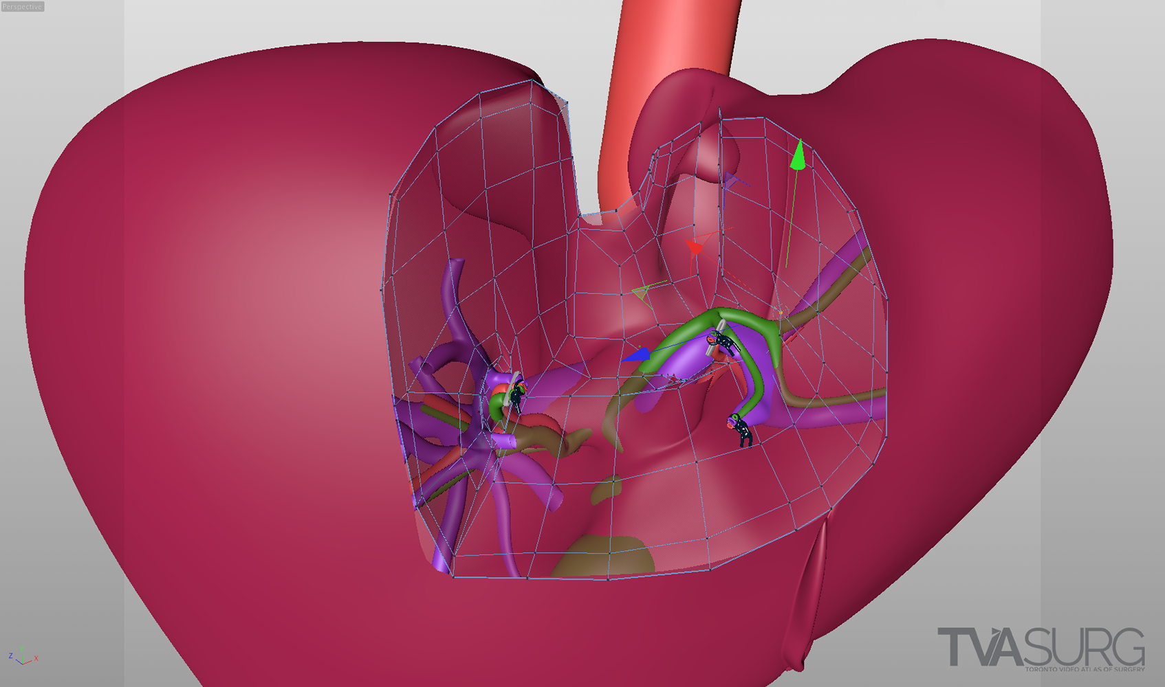 Segment 4a/8 resection plan