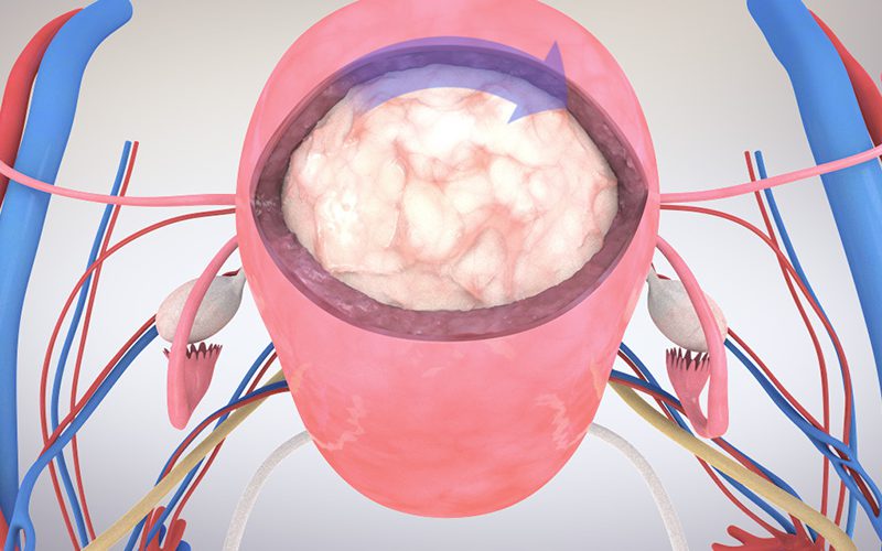 Laparoscopic Myomectomy