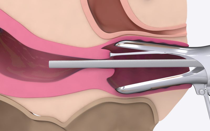 Basics of Hysteroscopy