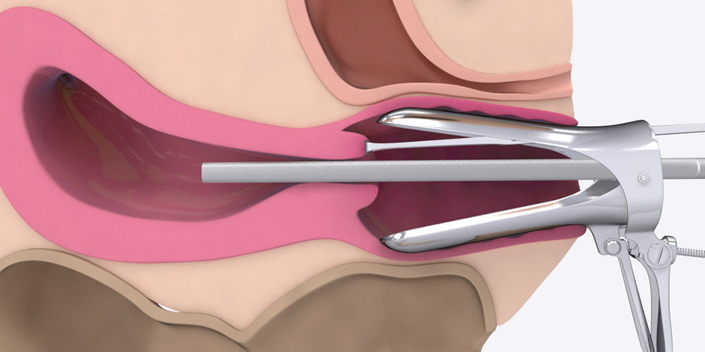 Basics of Hysteroscopy