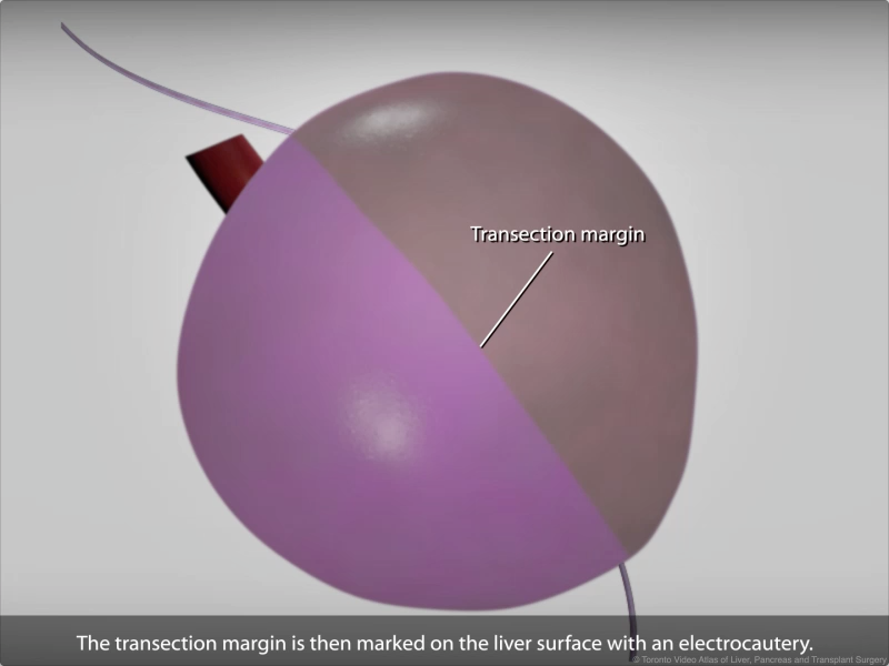 Donor 6/7 line of demarcation - animation