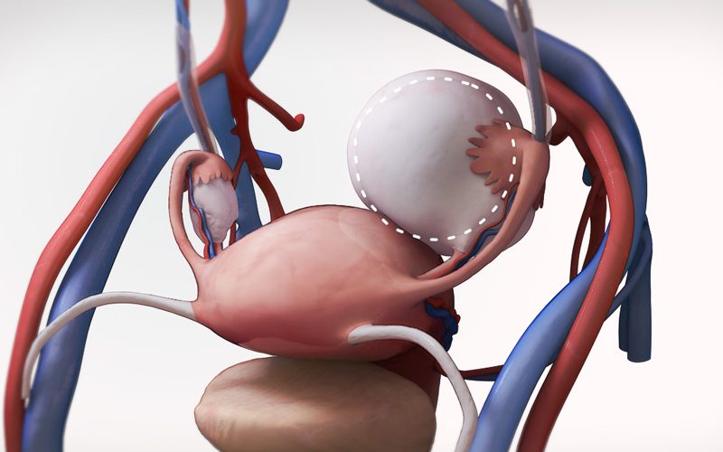 Laparoscopic Ovarian Cystectomy