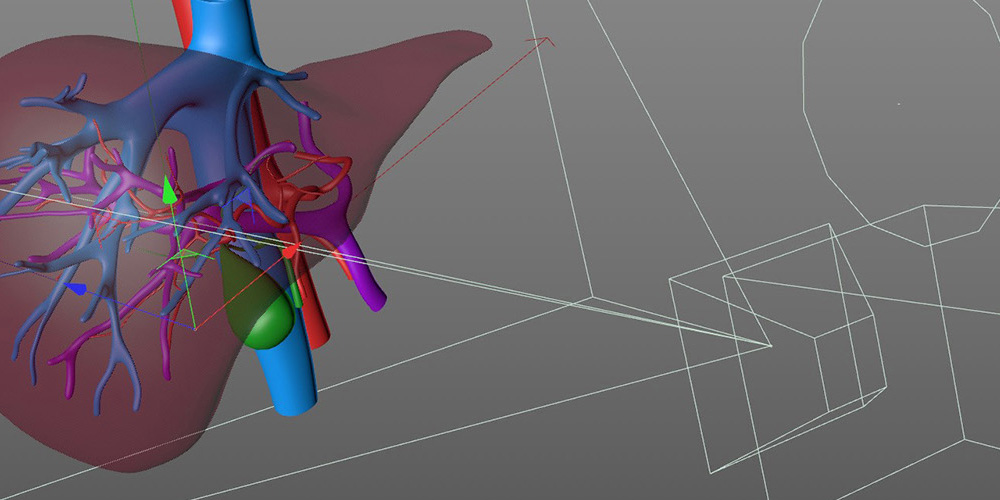 TVASurg Process: 3D Animation