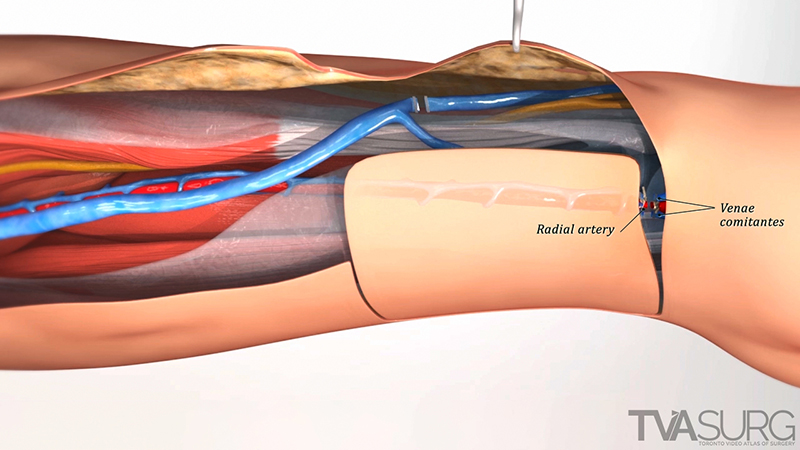 AMI 2020 Online Salon - Forearm flap harvest