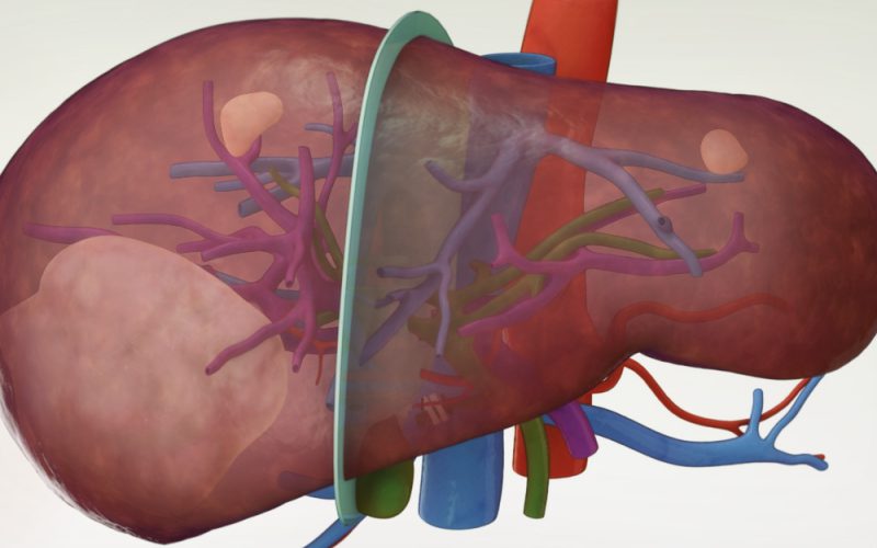 Laparoscopic right hepatectomy with Pringle maneuver