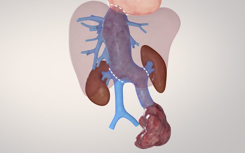 Right Hepatectomy with Cava Resection and Oophorectomy