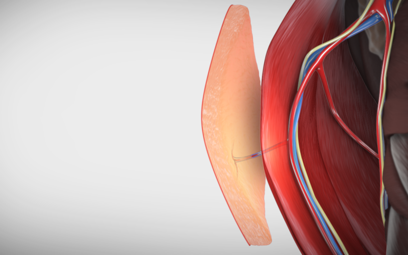 Thoracodorsal Artery Perforator Flap Harvest