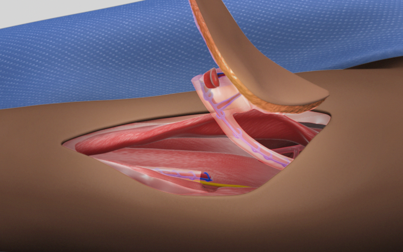 Anterolateral Thigh Perforator Flap Harvest