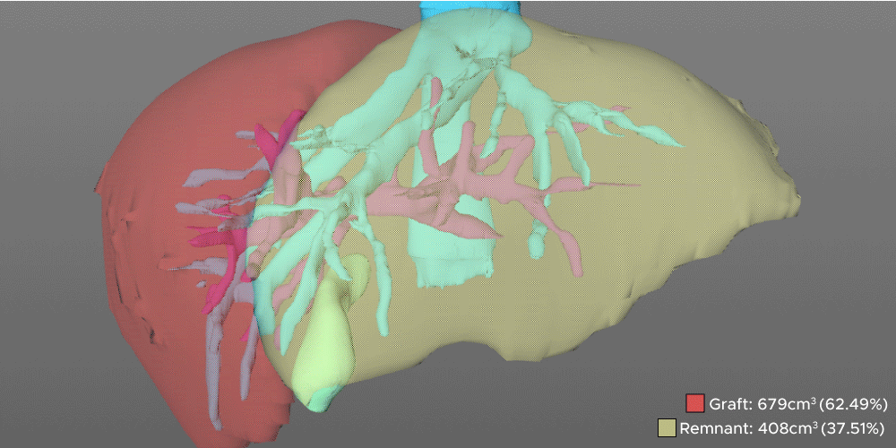 Tutorial: Utilizing 3D models for surgical pre-planning – Right lobe donor hepatectomy