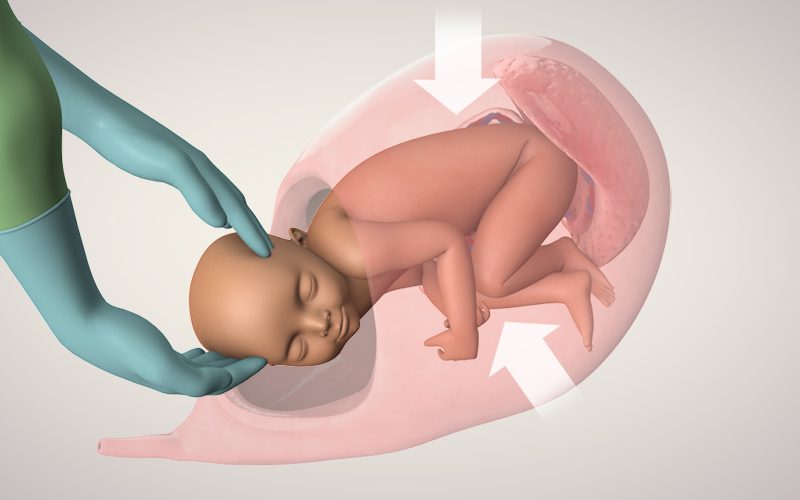 Caesarean Section in Patients with an Elevated BMI