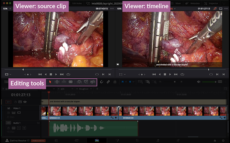 Surgical Video Editing with DaVinci Resolve