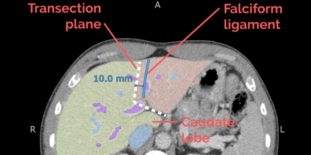 Tutorial: Utilizing 3D models for surgical pre-planning – Left lateral lobe donor hepatectomy