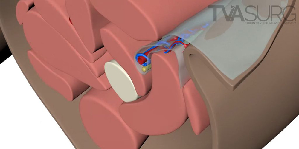 TVASurg Process : ALT perforator flap case-study