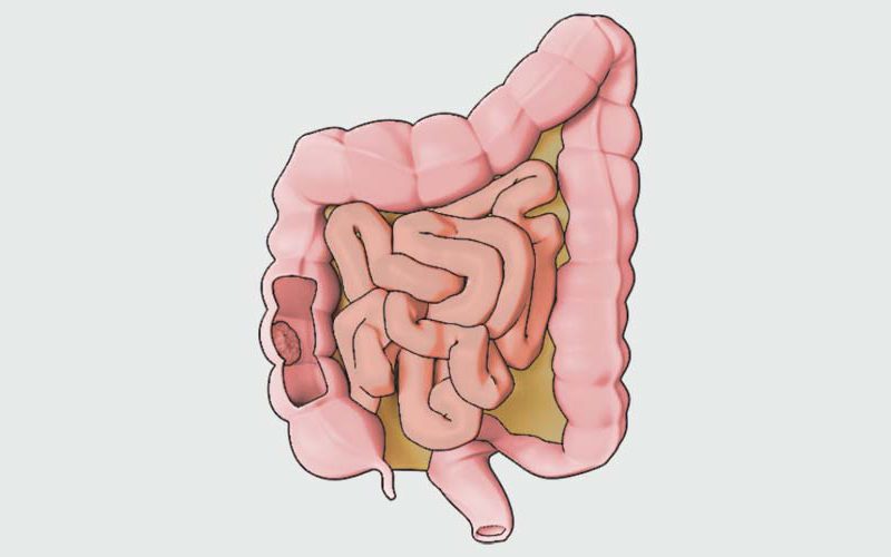 Patient Learning: Right Hemicolectomy