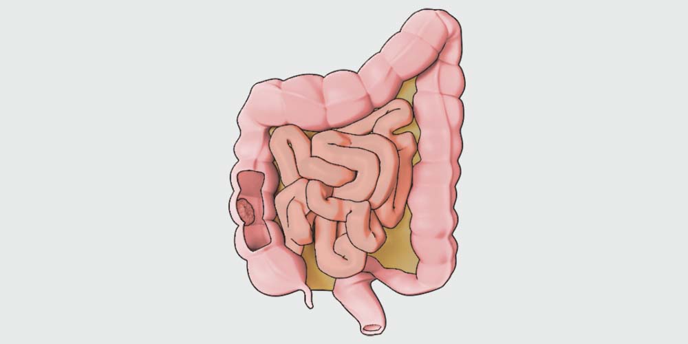 Biomedical communications for patient education in right hemicolectomy