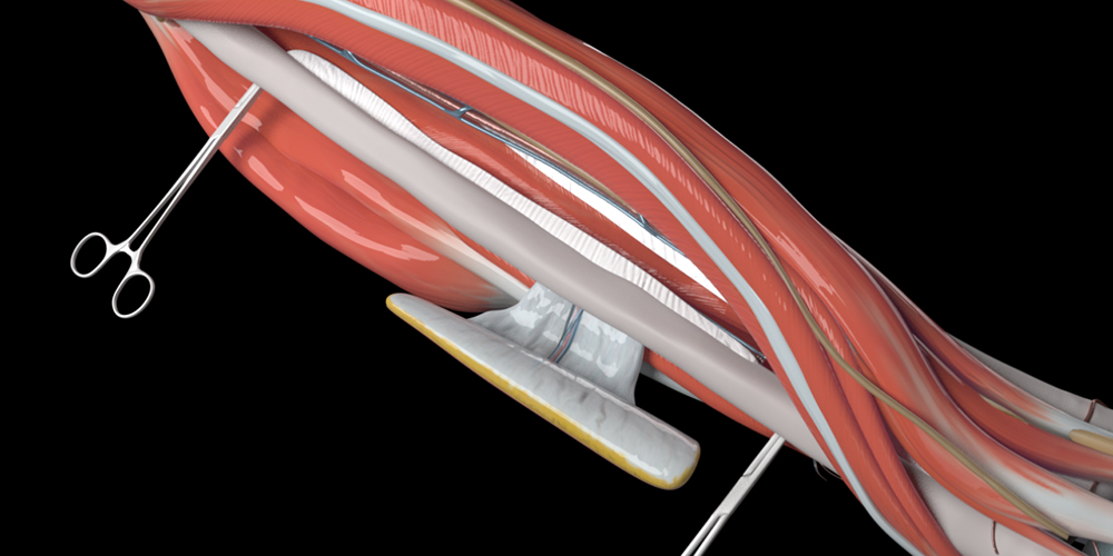 TVASurg Process: 3D Rendering