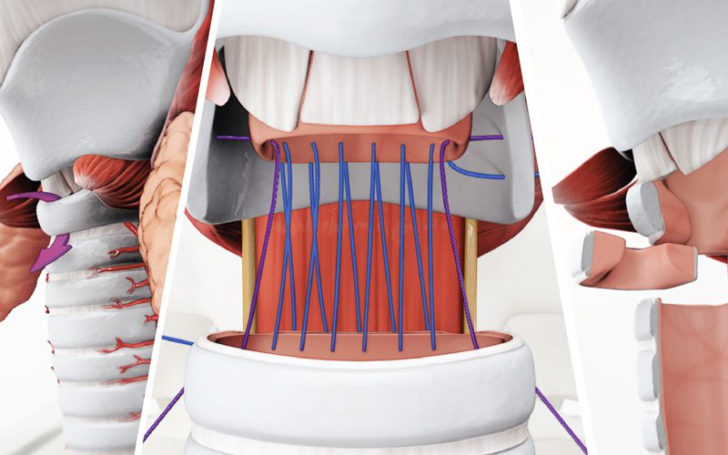 Cricotracheal resection for subglottic tracheal stenosis