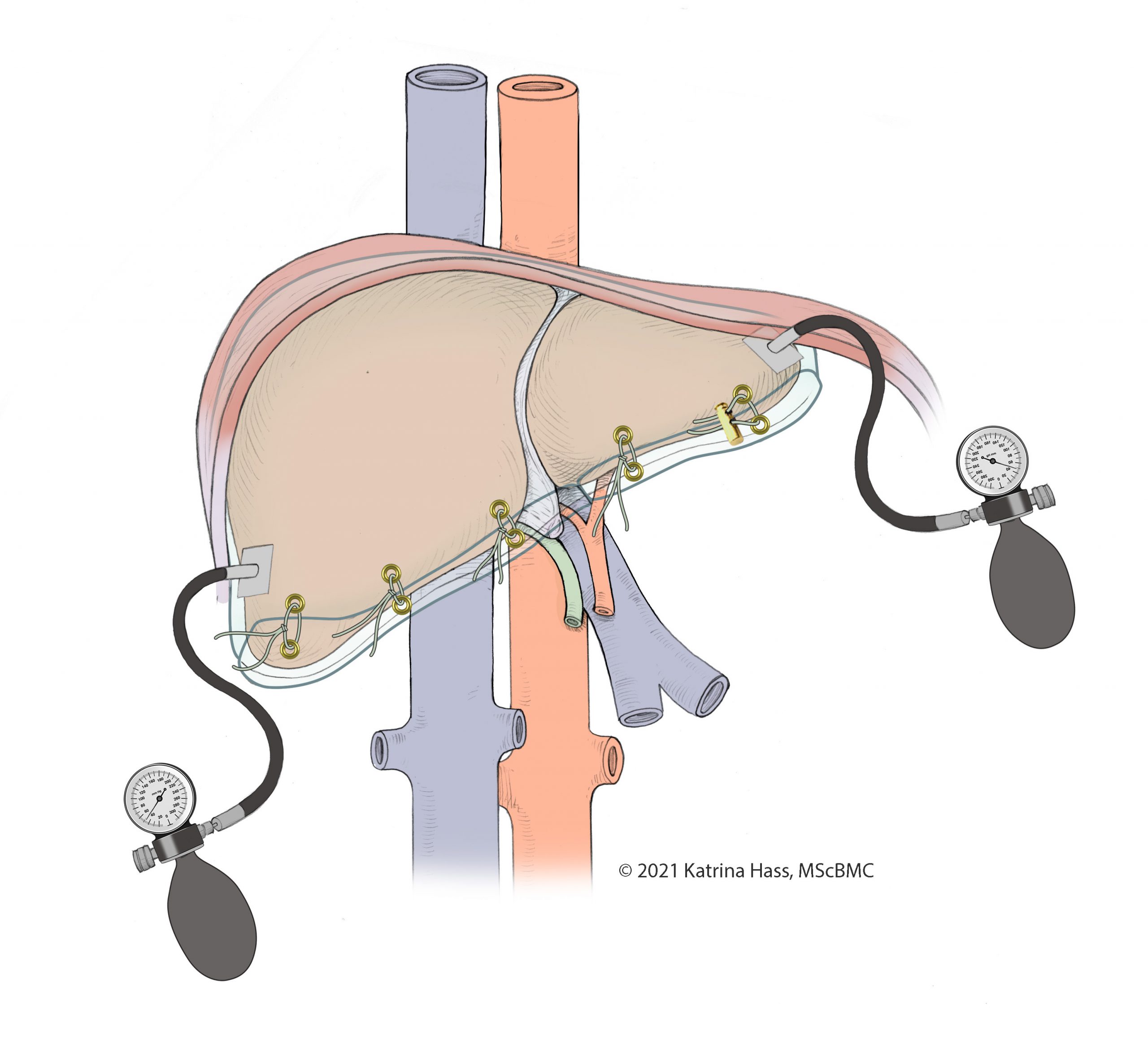 Initial Liver Airbag Concept