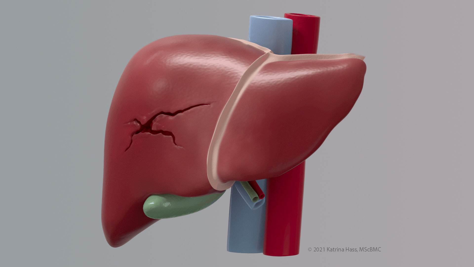 Traumatic liver injury