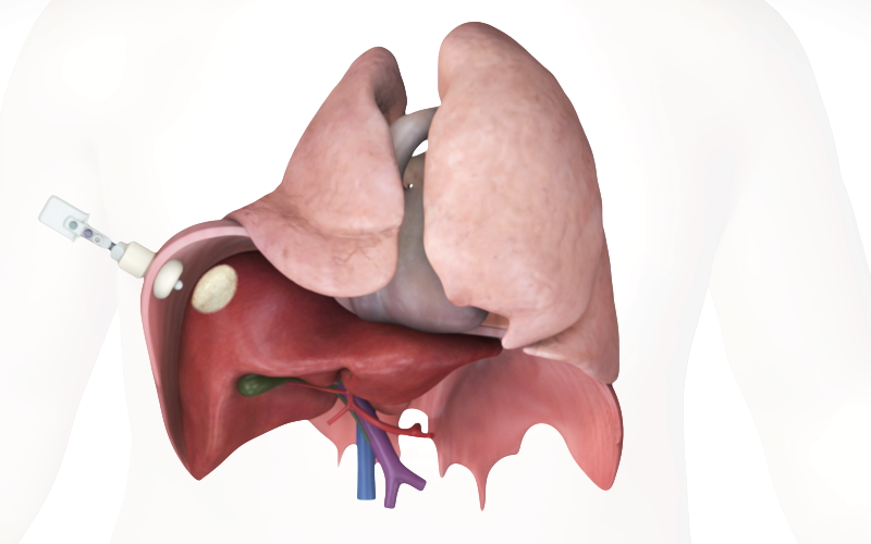 Segment 8 Laparoscopic Transection with the use of intercostal trans-diaphragmatic ports