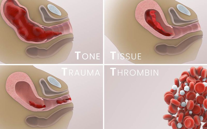 Management of Postpartum Hemorrhage