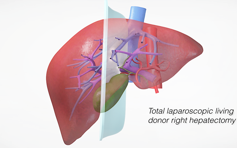 Laparoscopic Living Donor Right Hepatectomy