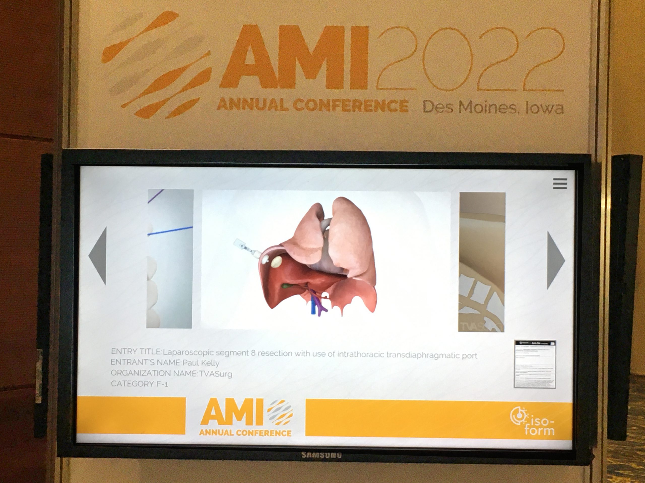 AMI 2022 Salon video - segment 8 liver resection