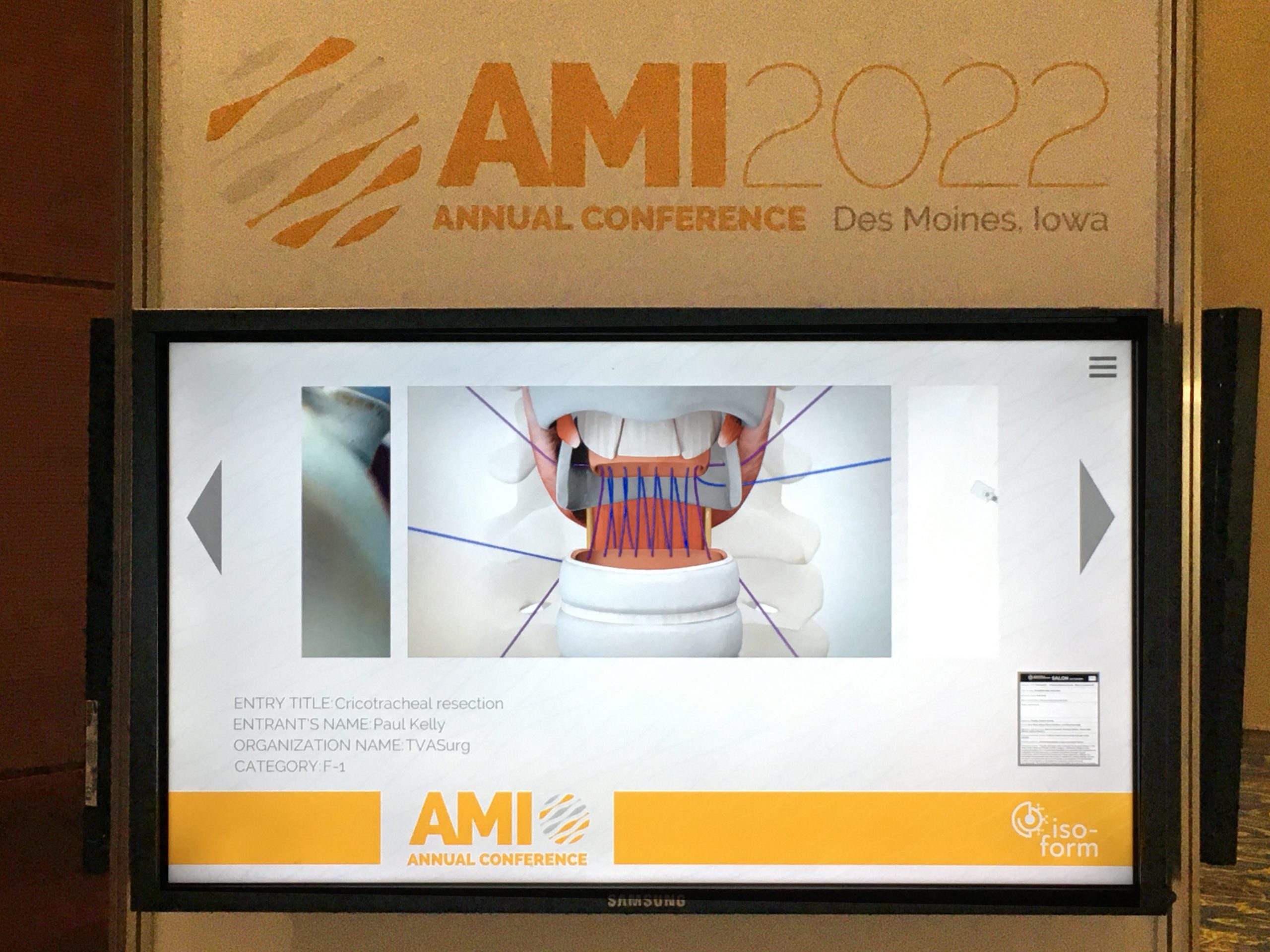 AMI 2022 Salon video - cricotracheal resection