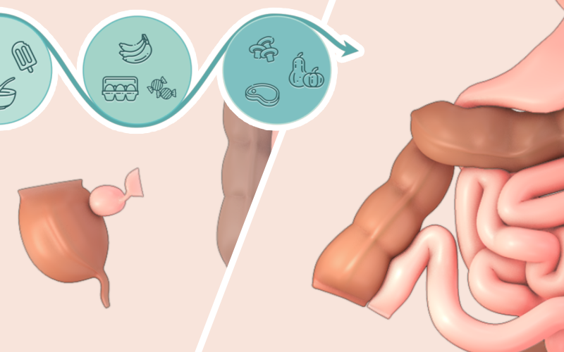 Patient Learning: Ileocolic resection for Crohn’s disease