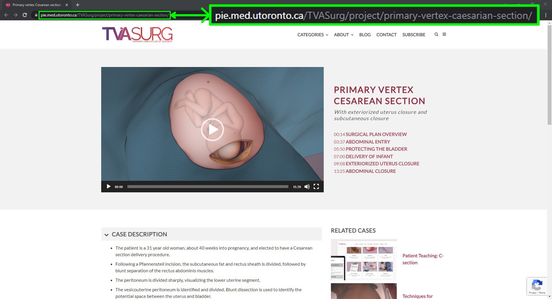 Cesarean section case page