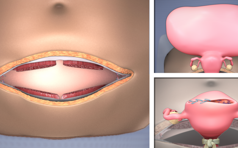 Abdominal myomectomy through Maylard incision