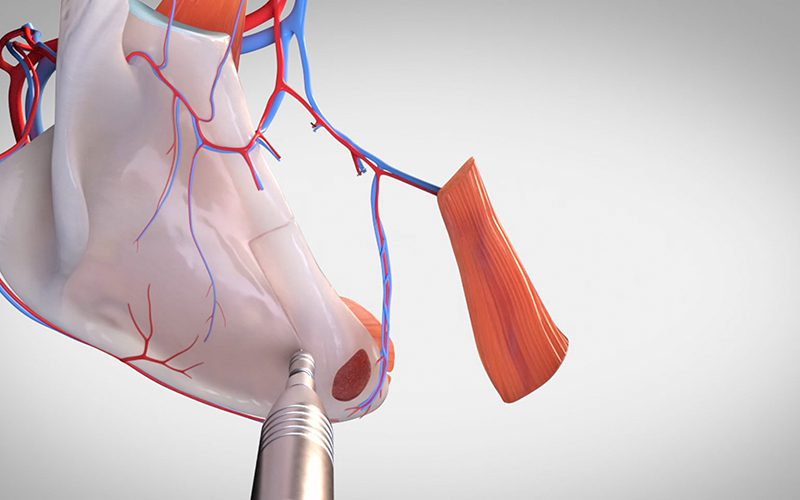 Scapula flap harvest