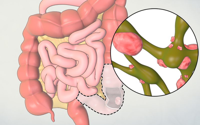 Patient Learning: Left Hemicolectomy/ Sigmoid Colectomy