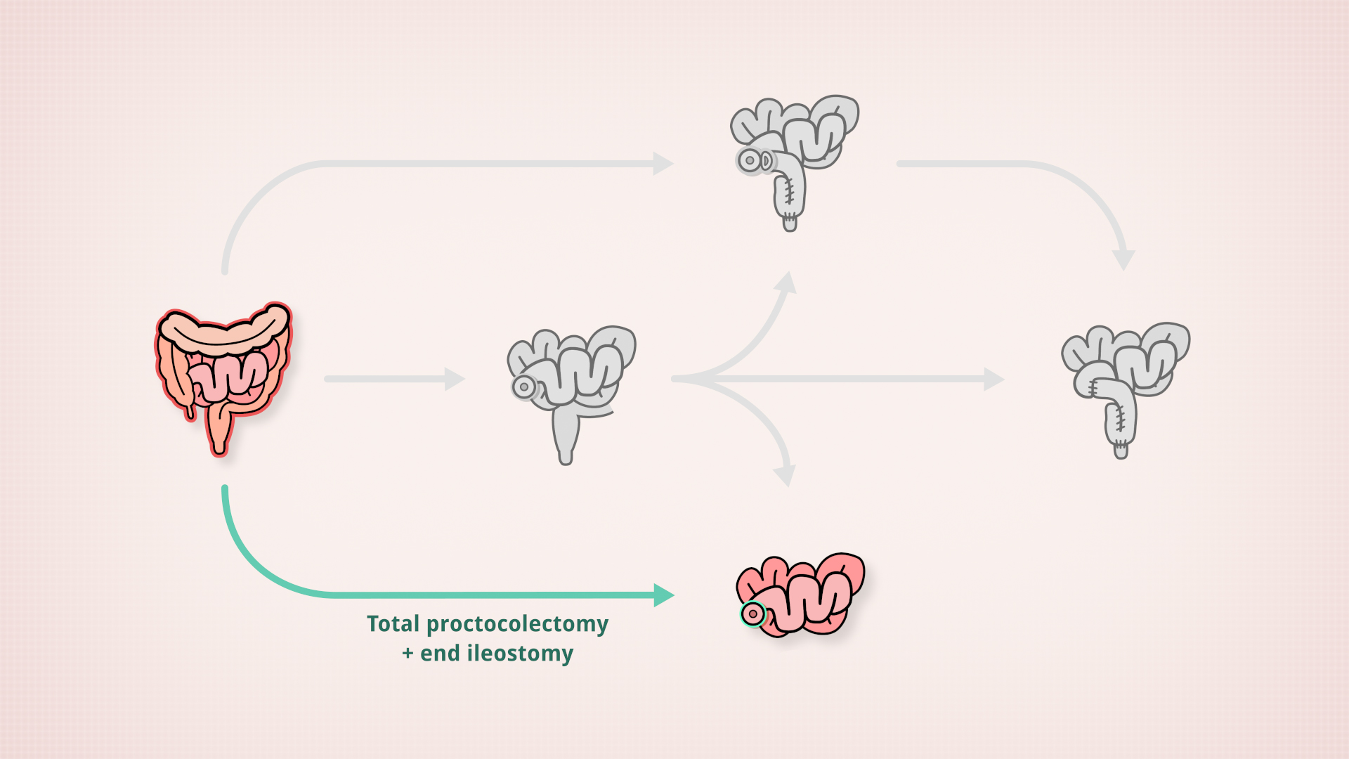 Total proctocolectomy + end ileostomy