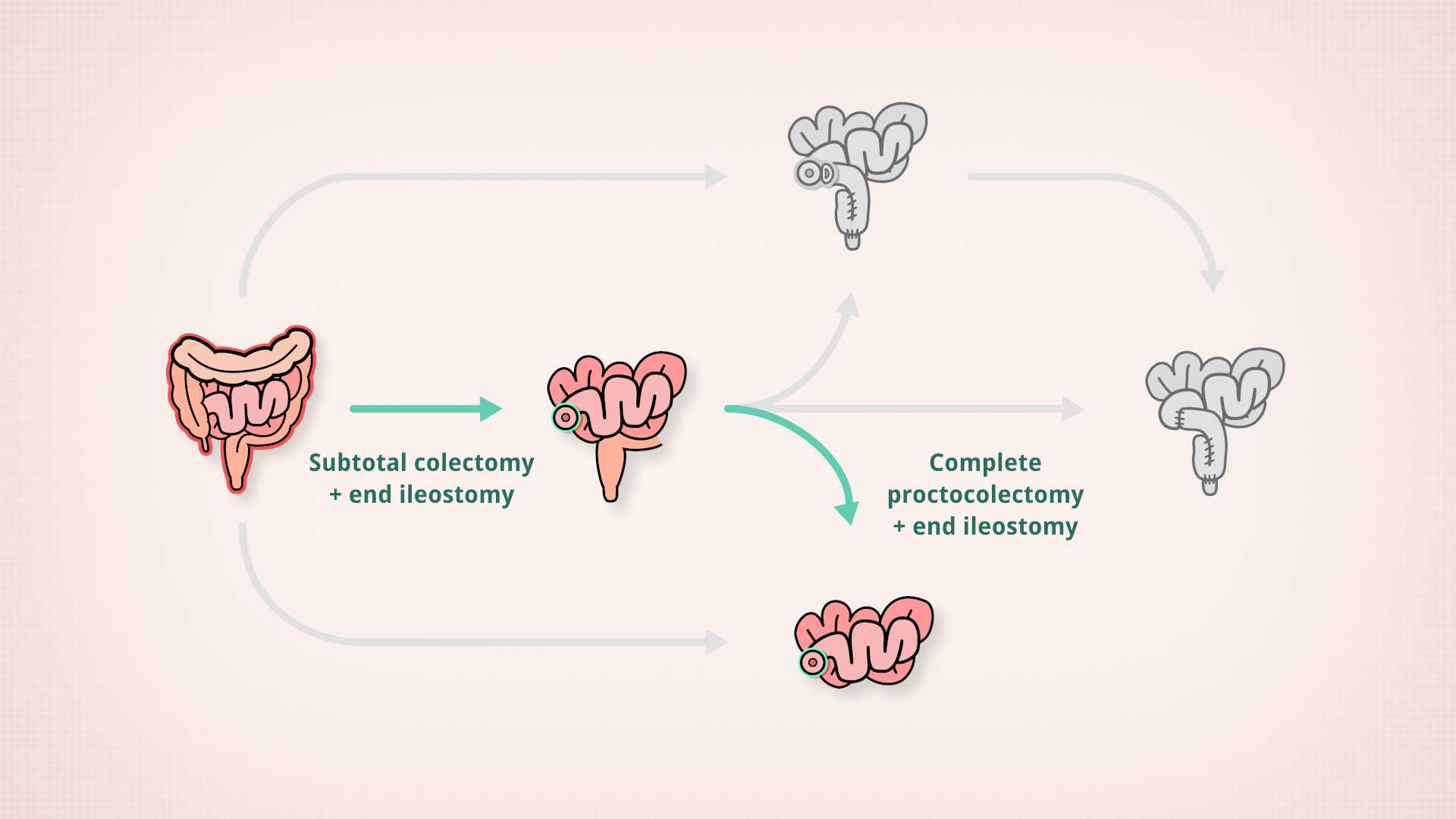 Subtotal colectomy > end ileostomy