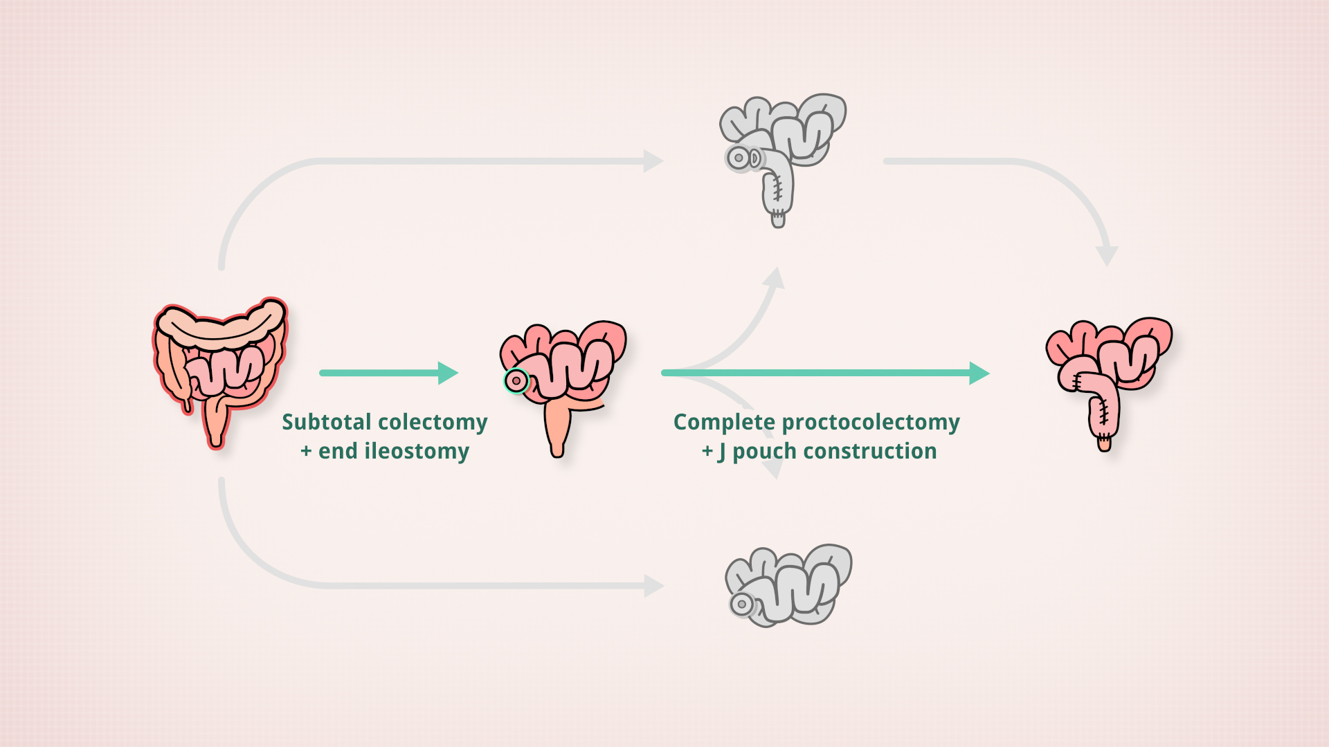 Subtotal colectomy > J pouch