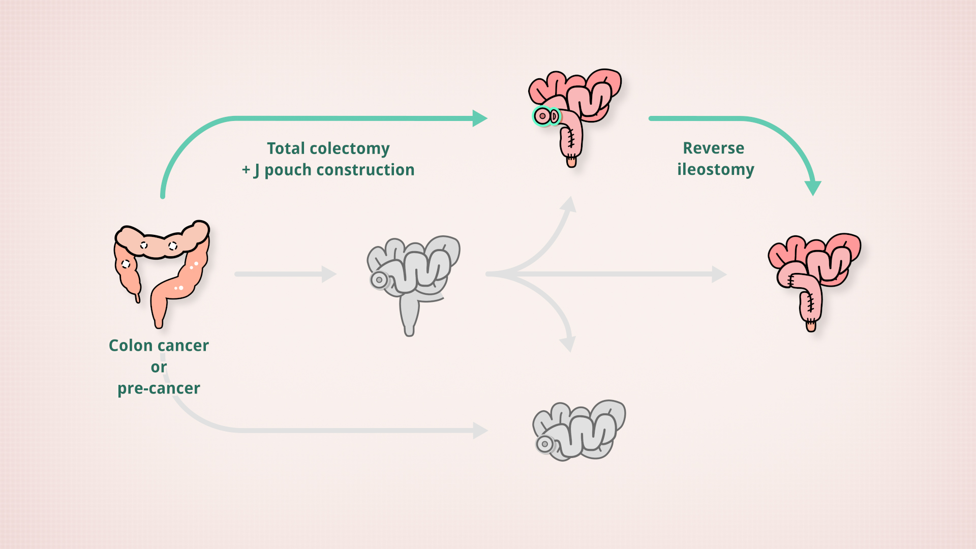 Total colectomy + J pouch > Reverse ileostomy