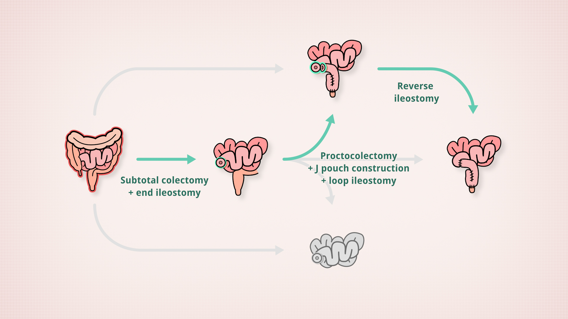 Subtotal colectomy > Loop ileostomy > Reverse ileostomy > J pouch