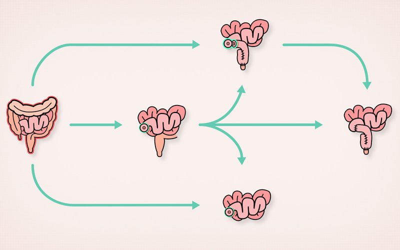 Patient Learning: Surgical treatment for ulcerative colitis